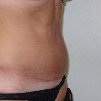 Side view of female patient after Abdominoplasty Surgery